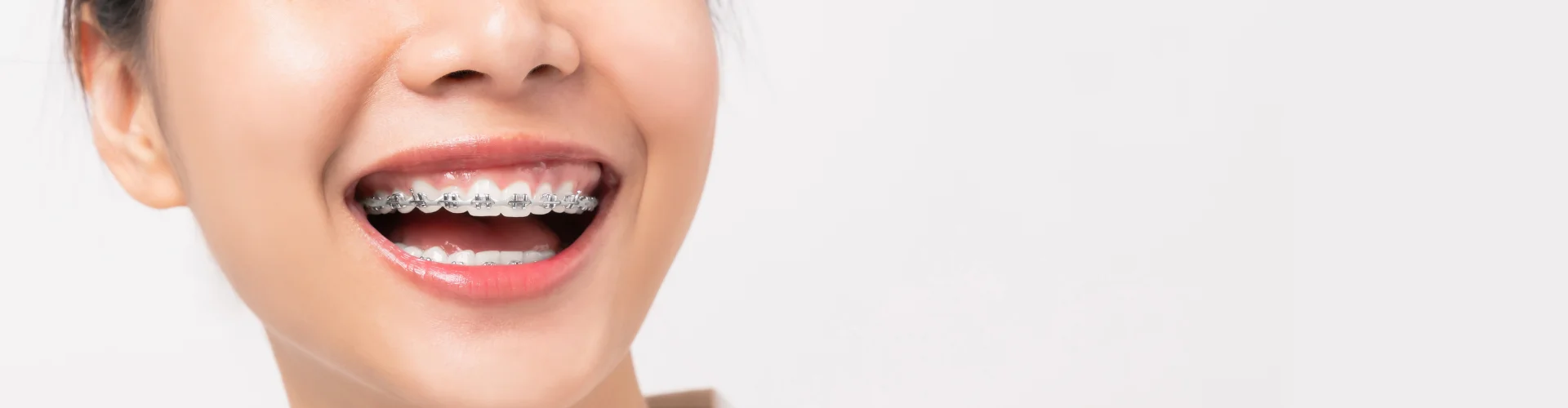 Braces Orthodontic Treatment in Navi Mumbai