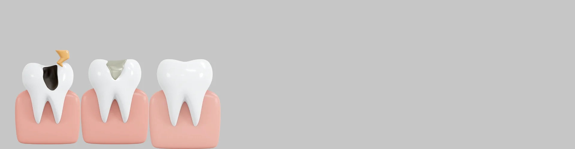 Dental Cavity and Fillings in Navi Mumbai