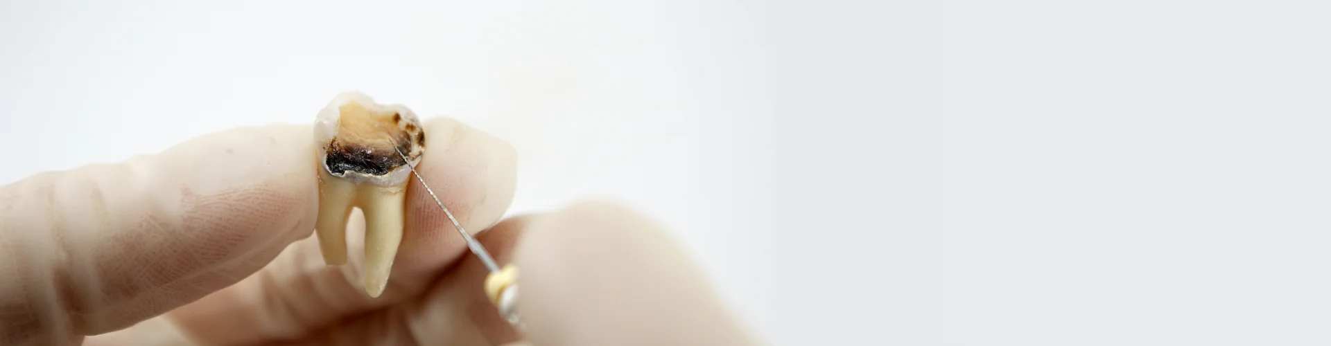 Root Canal Treatment in Navi Mumbai