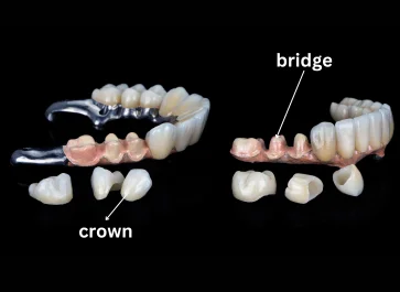 Expert crown and bridge treatment airoli navi mumbai