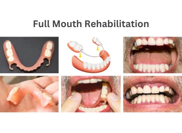 Full Mouth Rehabilitation Treatment