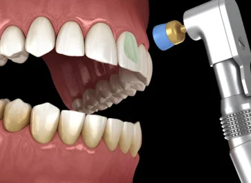 Scaling Polishing Treatment
