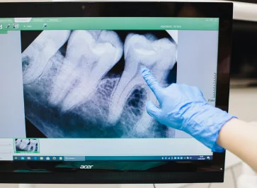 Wisdom Tooth Extraction Treatment