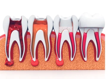 best root canal treatment airoli navi mumbai