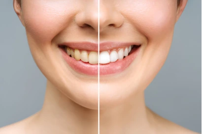 best teeth whitening treatment