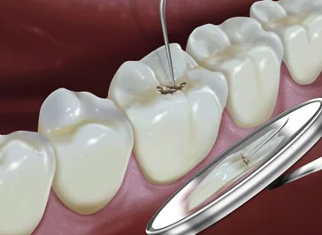 advance implants treatment airoli navi mumbai