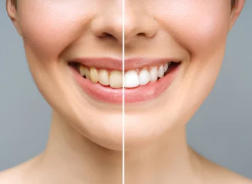 teeth whitening treatment airoli navi mumbai